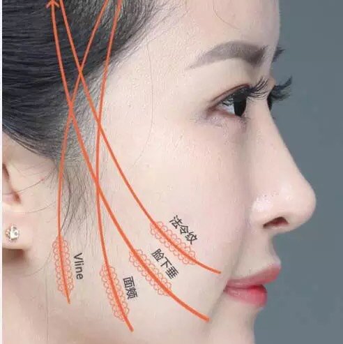 全脸线雕提升后面部凹陷线雕提拉最容易遇到蹈6个问题