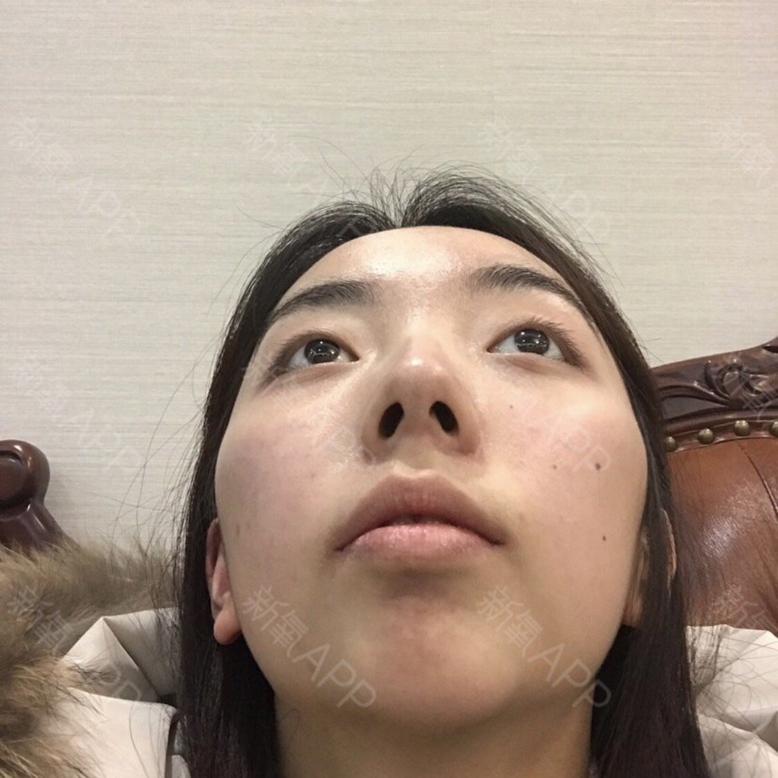 人生第一次整形手术给了下巴☺你的第一次整形手术是什_圈子-新氧美