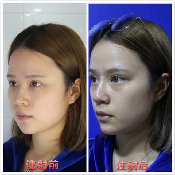 亲身体验告诉你如何选择玻尿酸