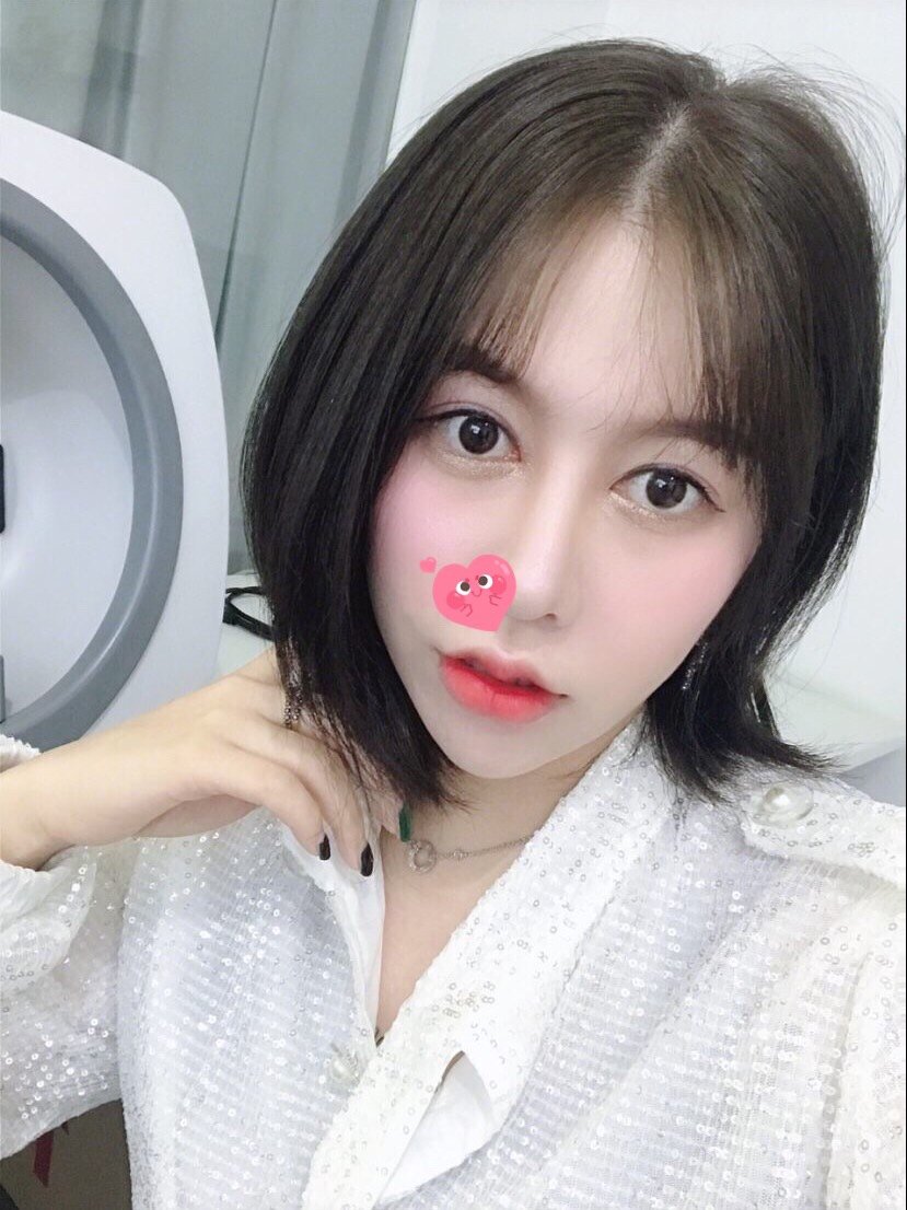 玻尿酸丰唇微笑花瓣唇～乔雅登3号填充～用了一支半形状已经很到位了