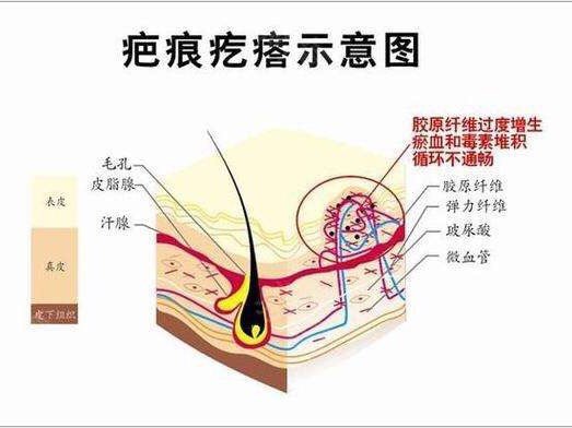 有人問肖叔,想知道什麼是疤痕體質?疤痕體質者在人群_圈子-新氧美容整