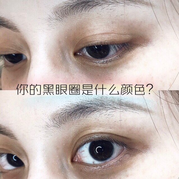 99作为眼部问题的战斗机,黑眼圈是桃桃比较困扰的一件_圈子-新氧