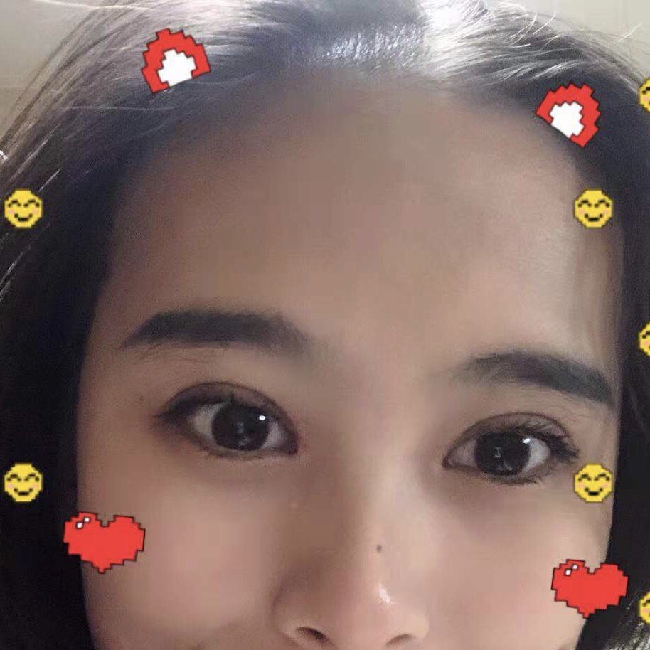 05三角眼割双眼皮需要注意什么呢00