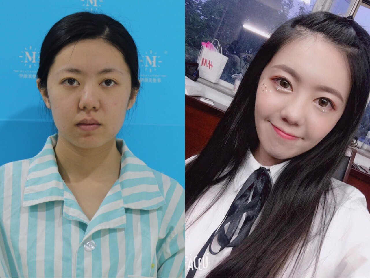 面部吸脂66615组对比照片99面部吸脂对比明显吗?