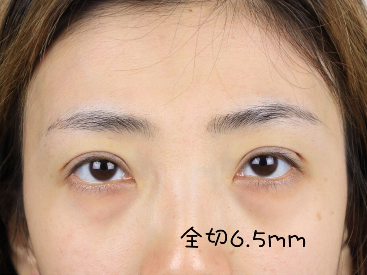 你知道吗?根据睑板设计双眼皮宽度最自然