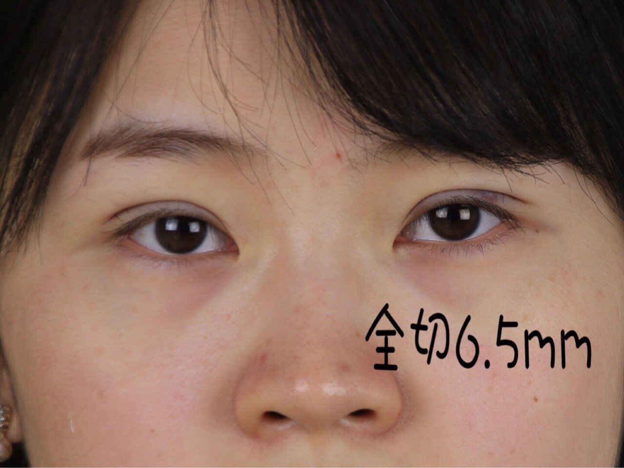 你知道吗?根据睑板设计双眼皮宽度最自然