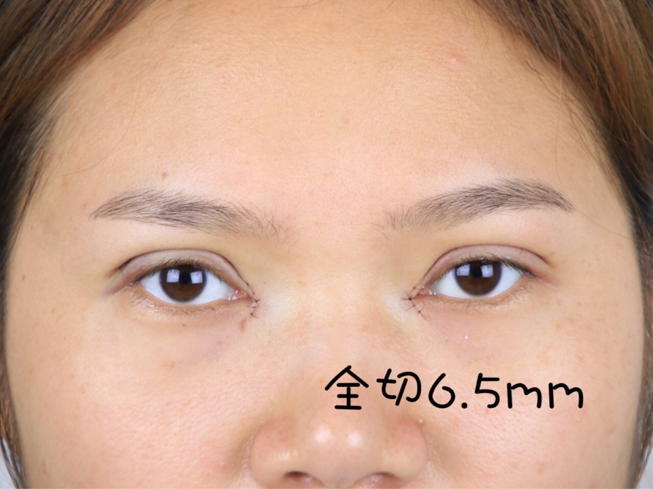 你知道吗?根据睑板设计双眼皮宽度最自然