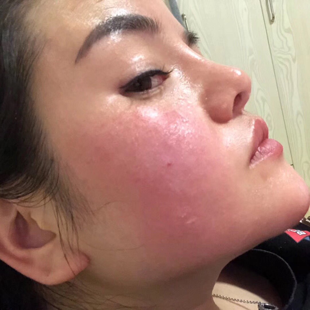 最难解决的肌肤困扰,isov产品治疗的真实案例