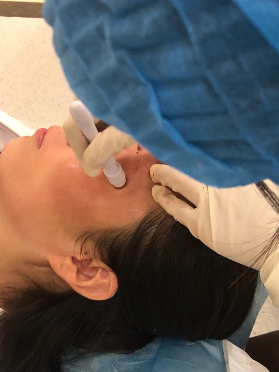 "微针疗法"又称微针疗法美容(microneedle therapy system,缩写为mts