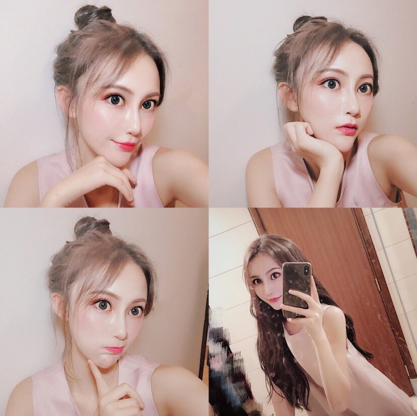 打了几针就变成了小可爱脸!我的变美史分享下