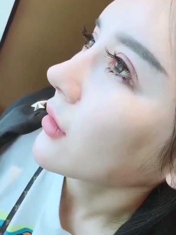 做了鼻修复 脂肪填充,网红感满满