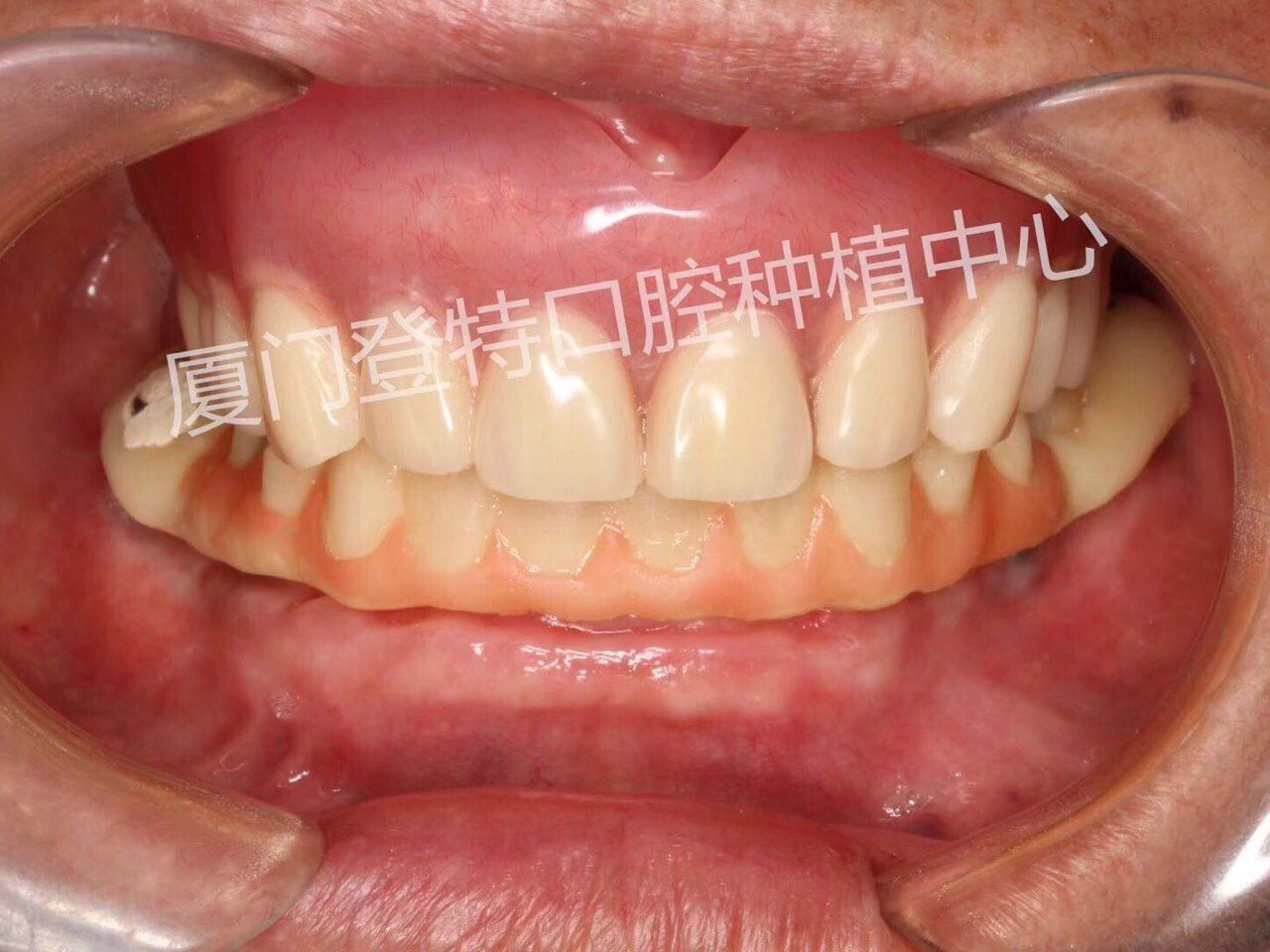 70岁阿嬷种了半口牙