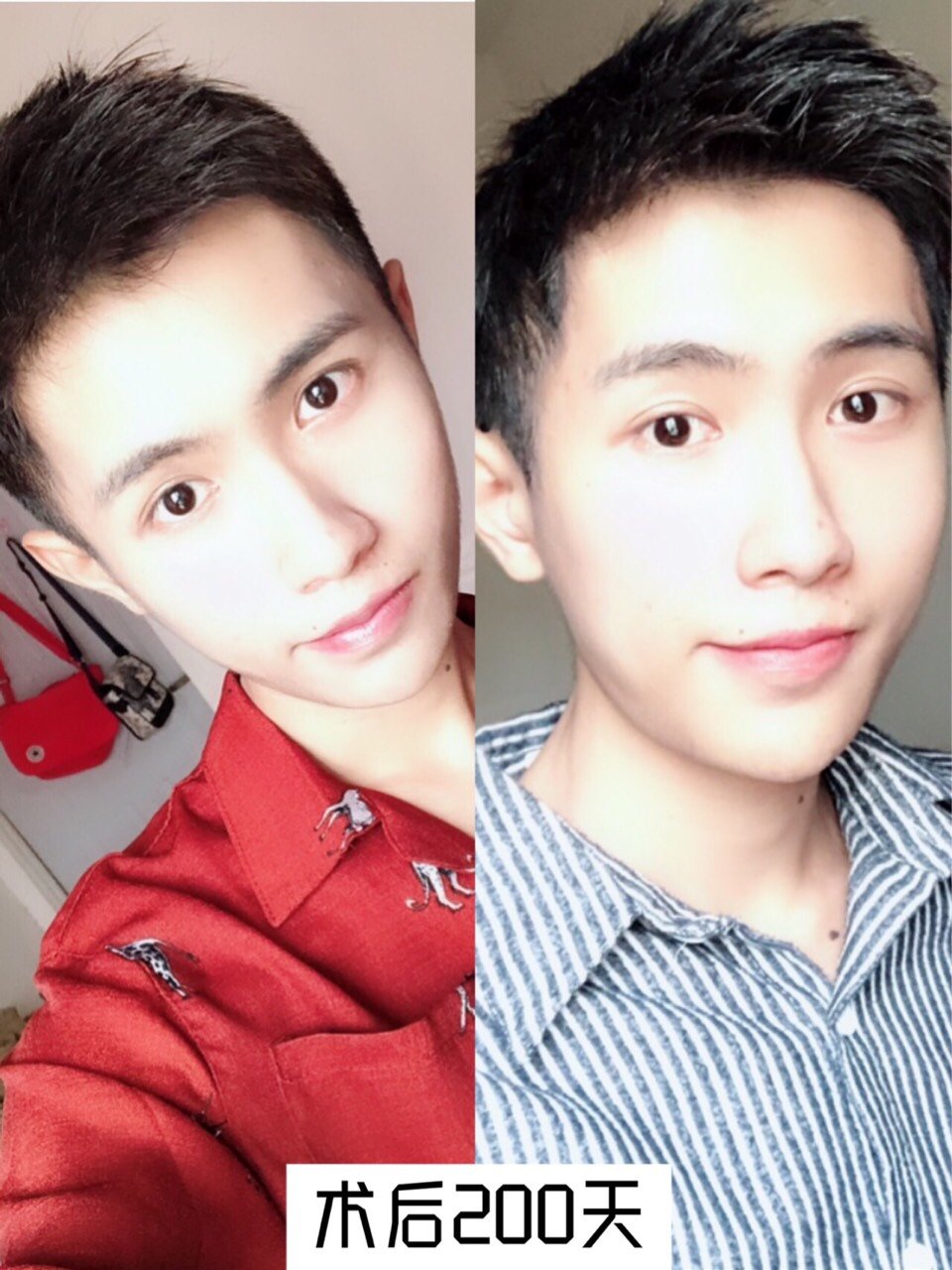 为什么男生不能做唇整形现在都快2019了