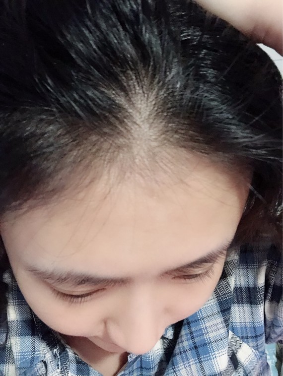 各位仙女好,你们的秃头54又上线了.前段时间我呕心_圈子-新氧美容整形