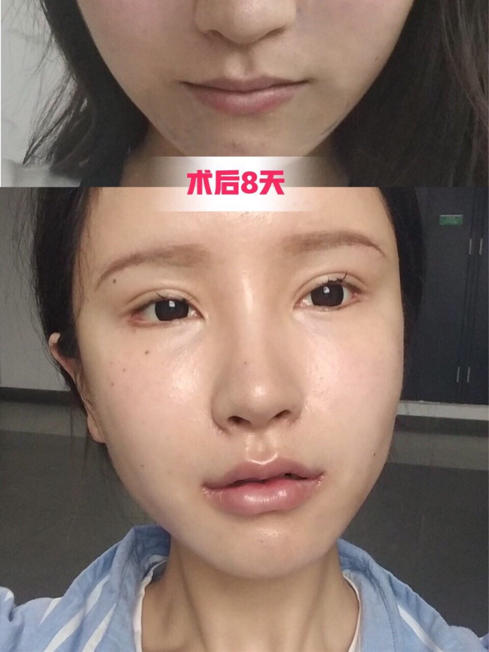 m唇综合手术后我终于认清了"整形"的本质