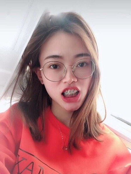 自锁牙套还没上钢丝的只沾了自锁托槽的牙套妹(爱称自己是牙套妹子啦)