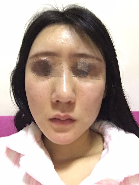 脂肪填充五次了,成活率不高怎么办,并且脸颊两侧有凹凸不平