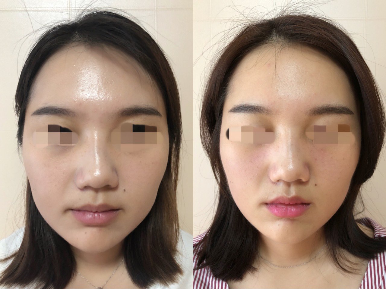 日式整骨小颜全记录