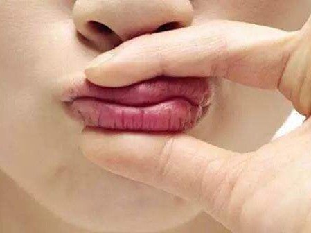 做微笑唇失败后,修复流程是怎样?