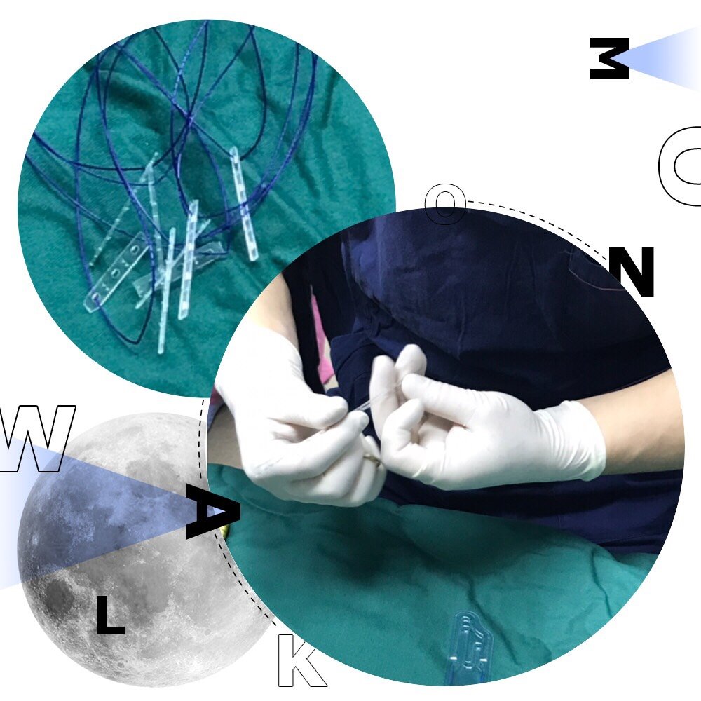 国内叫微拉美,这种材料是聚左旋_圈子-新氧美容整形