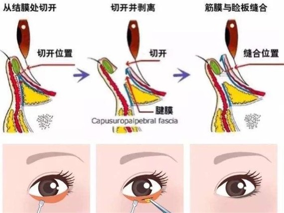 什么是下睑下至很多求美者咨询:什么是下睑下至手术?