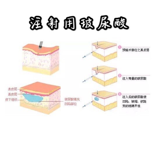 玻尿酸填充部位图图片