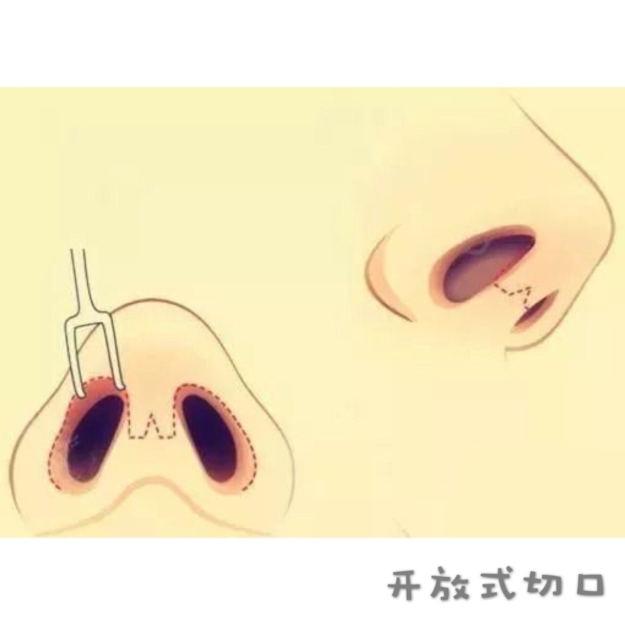 想做肋软骨,但是医生说我这个朝天鼻更适合鼻中隔软骨!真的吗?