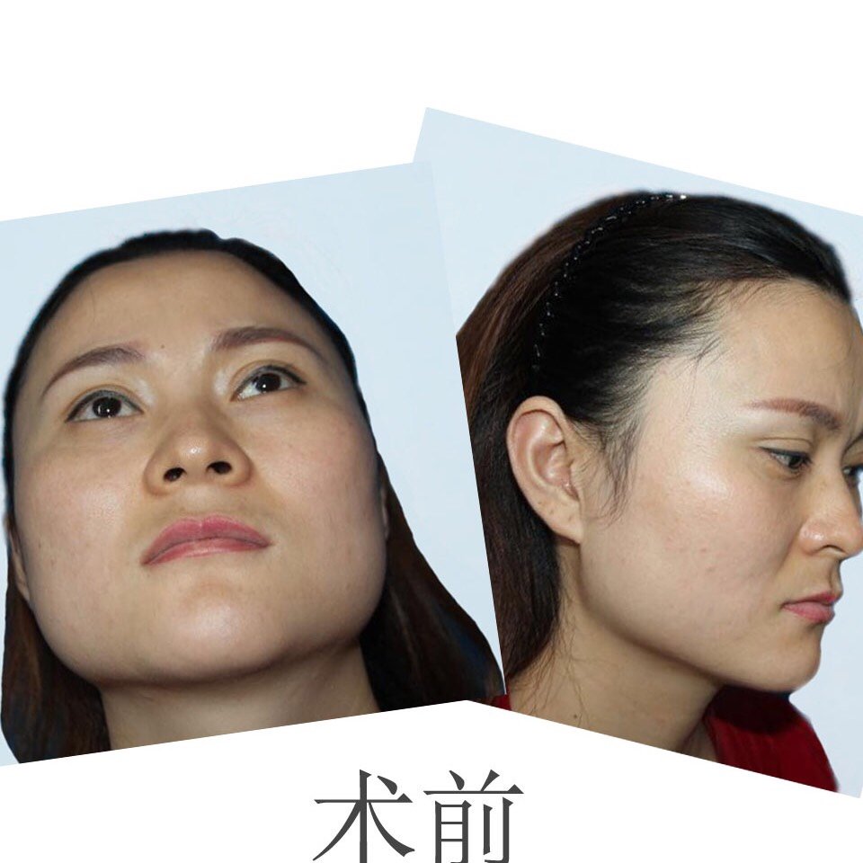 【下颌角磨骨 颧骨内推】 堪称上海"换头"案例