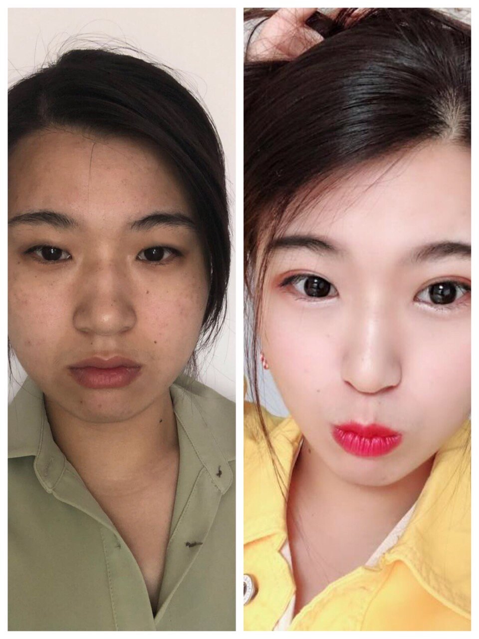 为什么医生说你不适合做宽的双眼皮?