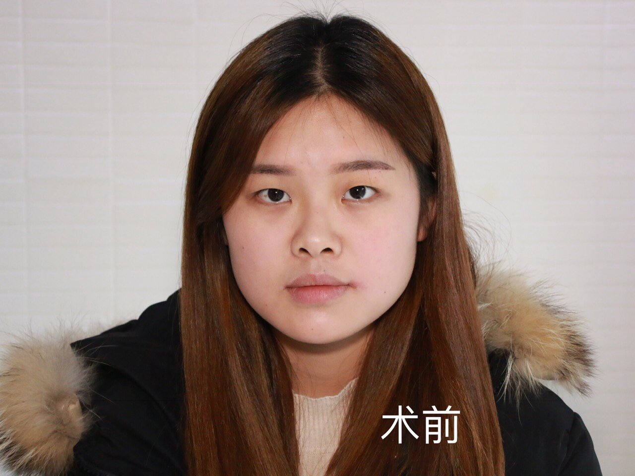 极致美妍医疗美容诊所 成都双眼皮 徐彬  今日份案例: 全切双眼皮.6.