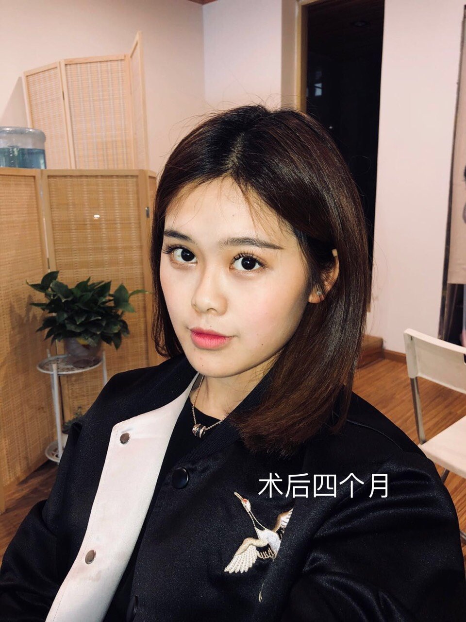 [黄金薯r][:147]吊梢眼做眼睑下至效果好吗?_圈子-新氧美容整形