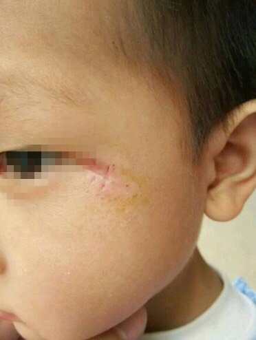 孩子意外摔伤后,如何预防形成疤痕?