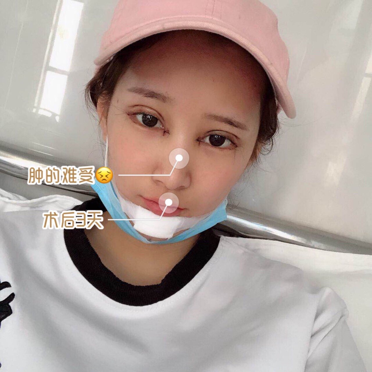 "割过双眼皮"的10位明星,戚薇美出新高度,薛之谦像换了一个人.