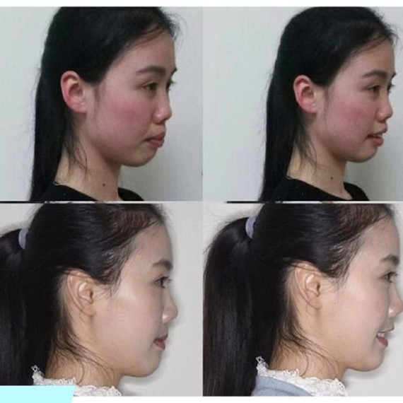 拔牙正畸脸型塌陷照片拔牙矫正嘴巴瘪了图片矫正牙齿内收过多嘴瘪拔牙