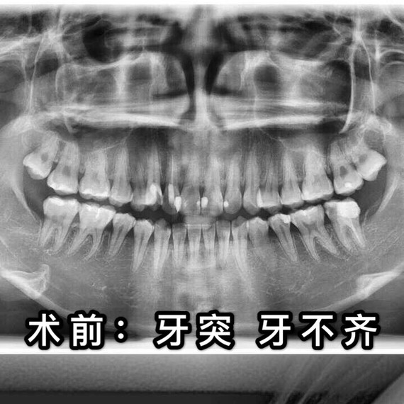 【牙突嘴突矫正改变脸型】#记录虎牙矫正#绝