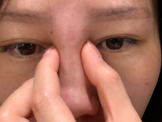 16年鼻子打过玻尿酸,今天一大早起来鼻梁突然变肿变宽了!