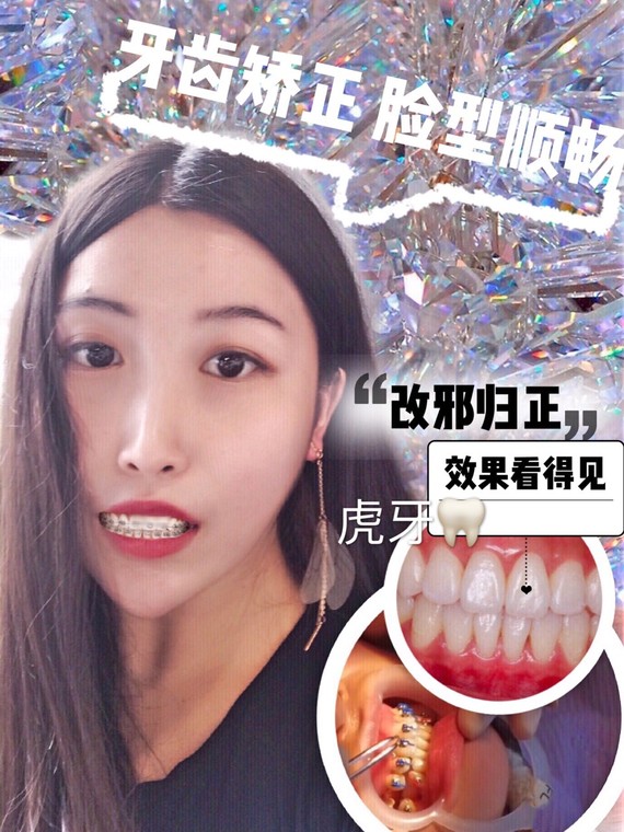 【牙突嘴突矫正改变脸型】#记录虎牙矫正#绝