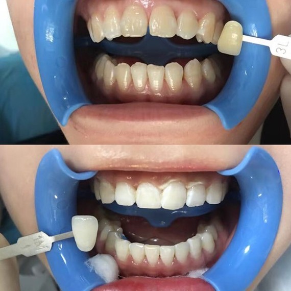 宝宝冷光美白记