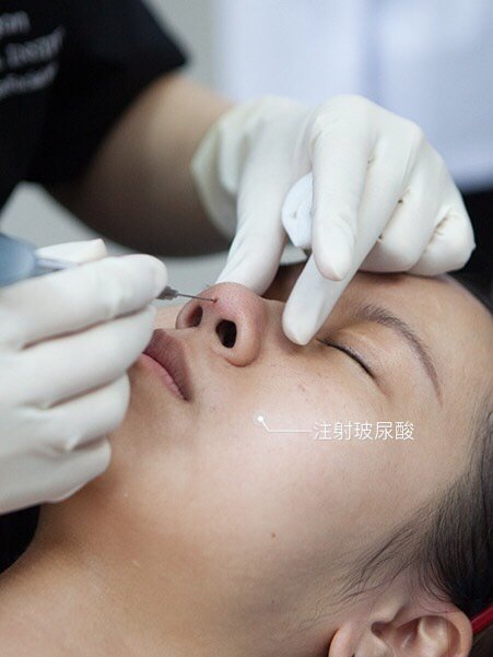 91玻尿酸隆鼻效果好不好7171719199鼻子说了算9191玻