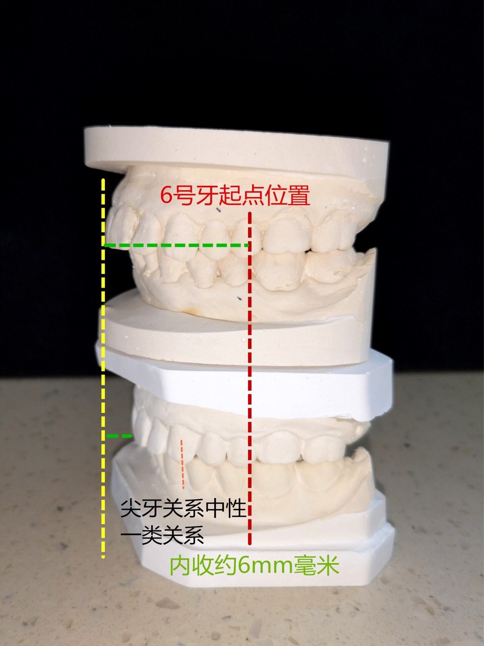 牙齒片切的那些事