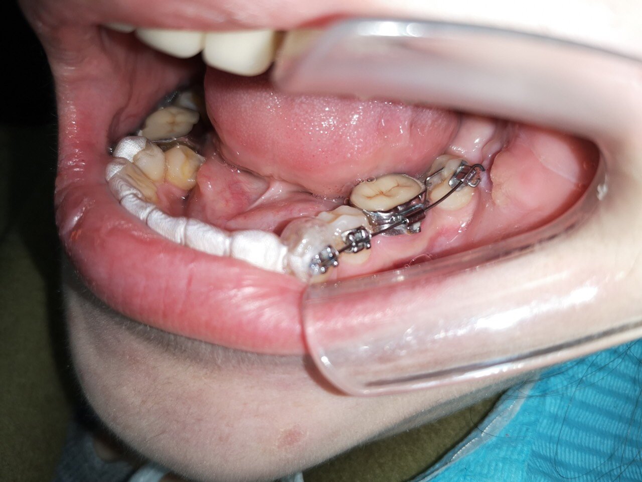 烤瓷牙,如果做隐形就需要拆除,患者不愿意,那么就使用带环套起来治疗