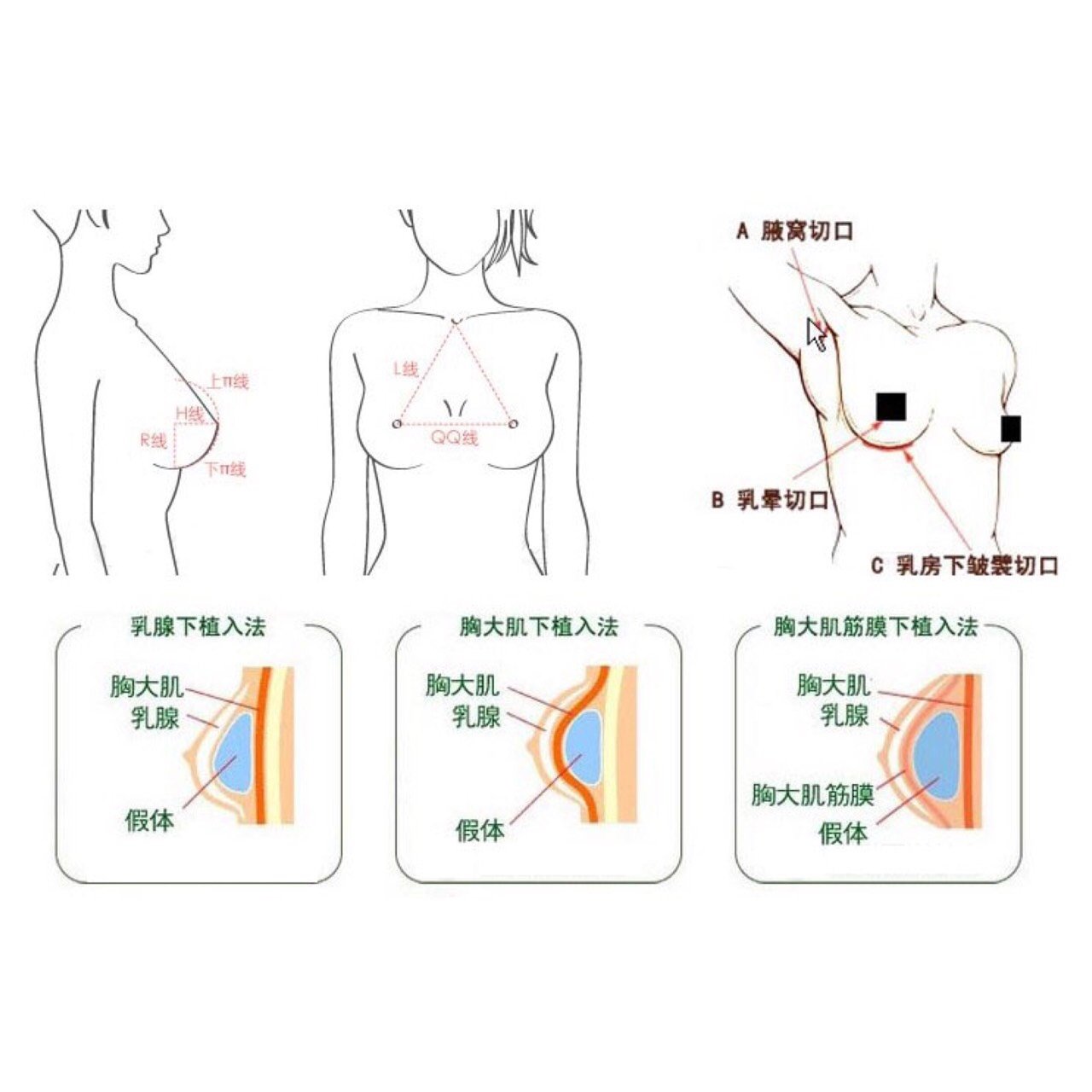 你对假体隆胸有哪些误会?