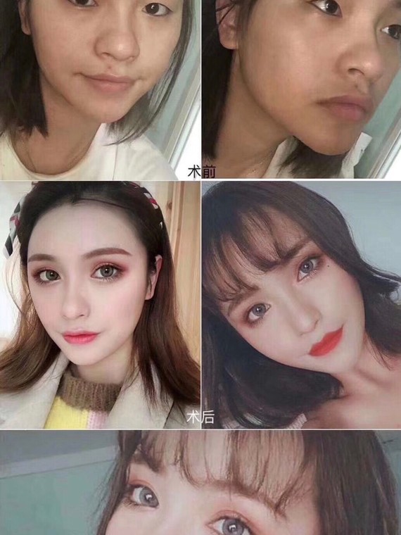 如何判断你的双眼皮需不需要提肌?