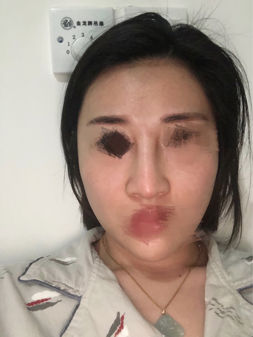 懂得快帮我看看假体耳软骨隆鼻25天鼻子很宽特别丑还歪,尤其是山根