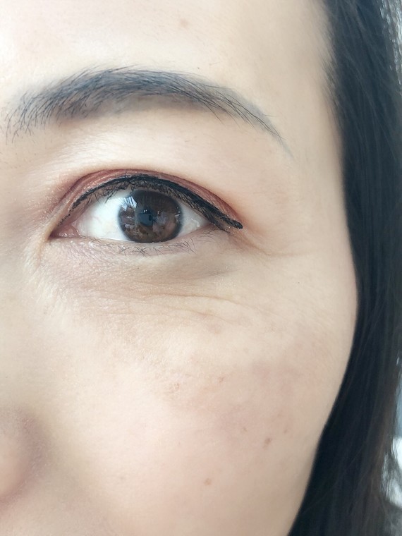 各位大佬们,麻烦帮忙看看这种眼底皱纹要做什