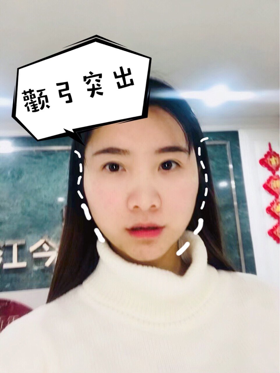 【填充了两次太阳穴,为什么还是颧弓突出?】