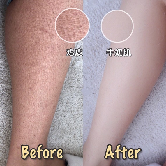 大腿抽脂多久可以用身体乳(大腿抽脂多久可以用身体乳擦)