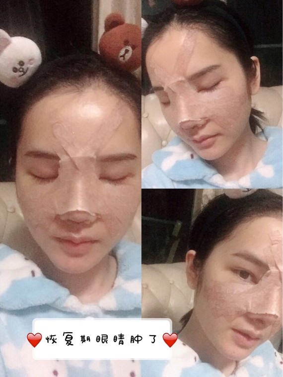 我有一个朋友之前做了大号型硅胶假体,当时鼻子做的很高,效果也是很