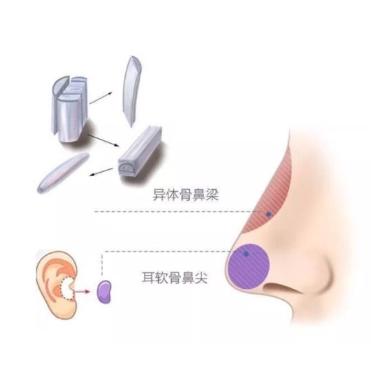 异体肋软骨隆鼻?靠谱吗?在出现了肋软骨隆鼻