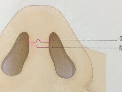 隆鼻手术的切口,一般分为开放式切口_圈子-新氧美容整形